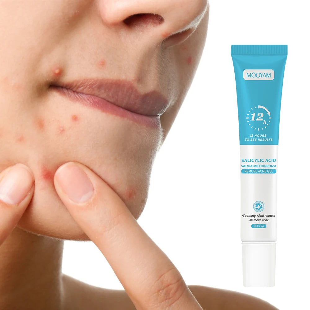 3st Fast Effective Acne Gel 20gr - 24 Timmar Deals