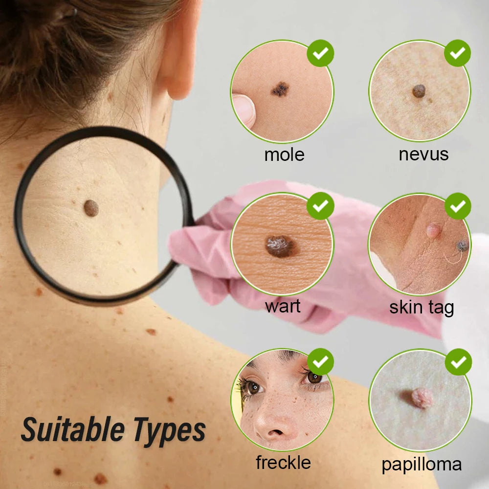 Skin Tag Remover Laser Plasma Pen Dark Spot Mole Wart Remover - 24 Timmar Deals
