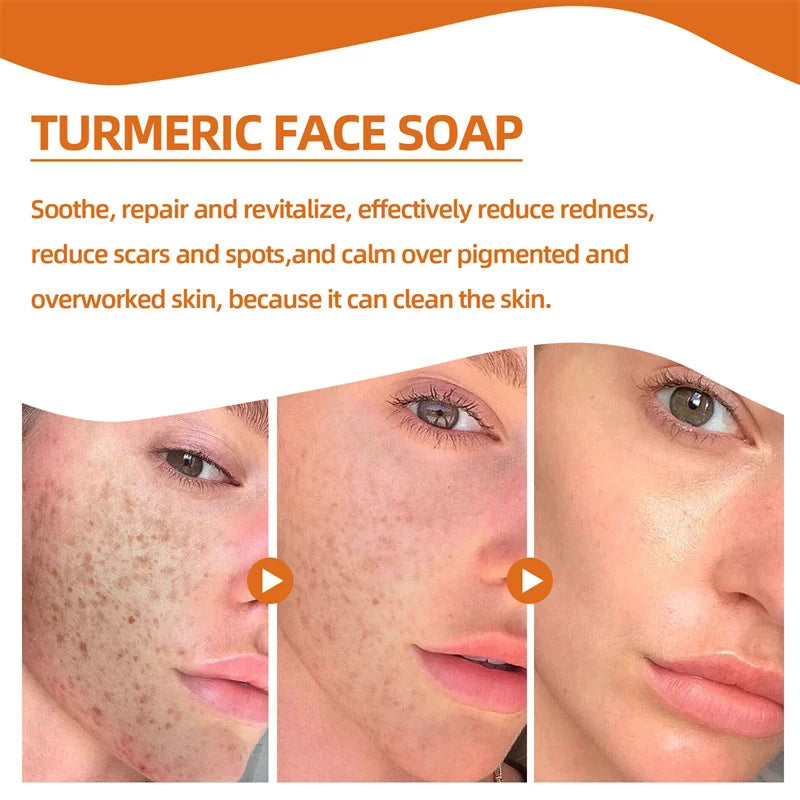 Kojic Acid Soap Handmade Whitening Soap Brightening skin Lighten Dark Spot Turmeric Soap Acne Scare Removal Cleaning Skin - 24 Timmar Deals