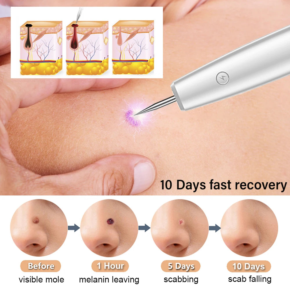 Skin Tag Remover Laser Plasma Pen Dark Spot Mole Wart Remover - 24 Timmar Deals
