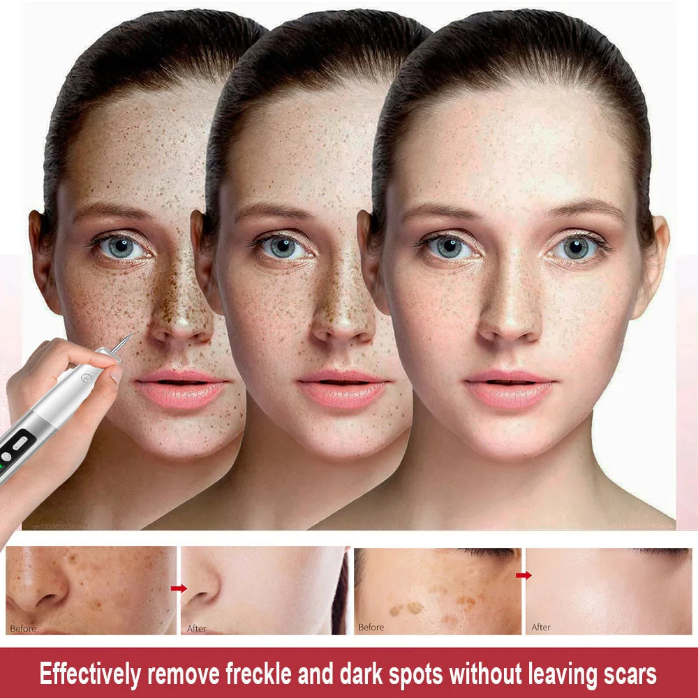 Skin Tag Remover Laser Plasma Pen Dark Spot Mole Wart Remover - 24 Timmar Deals